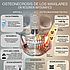 Osteonecrosis de los maxilares: diferencias entre MRONJ y osteoradionecrosis