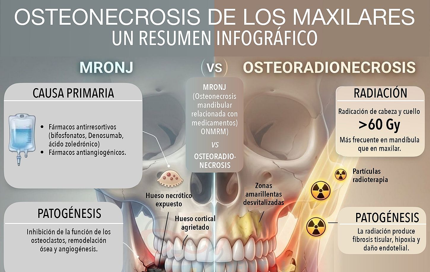 Osteonecrosis de los maxilares: diferencias entre MRONJ y osteoradionecrosis