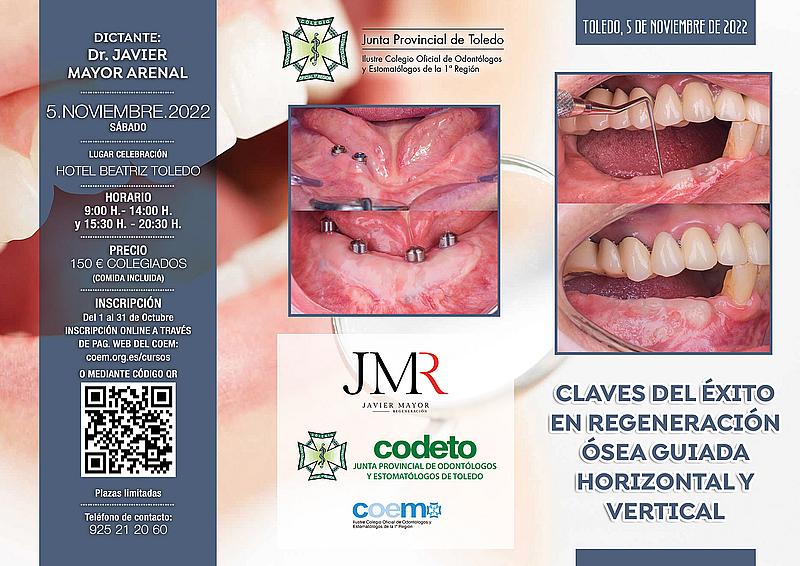 curso Claves del éxito en regeneración ósea guiada horizontal y vertical